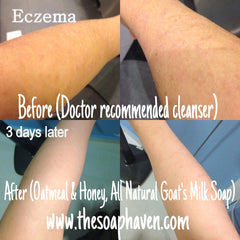 Healed from Eczema before and after picture using The Soap Haven Oatmeal Honey Goat Milk Soap