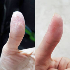 before and after image of thumb with eczema 1 week after using The Soap Haven Goat Milk Oatmeal Honey Soap